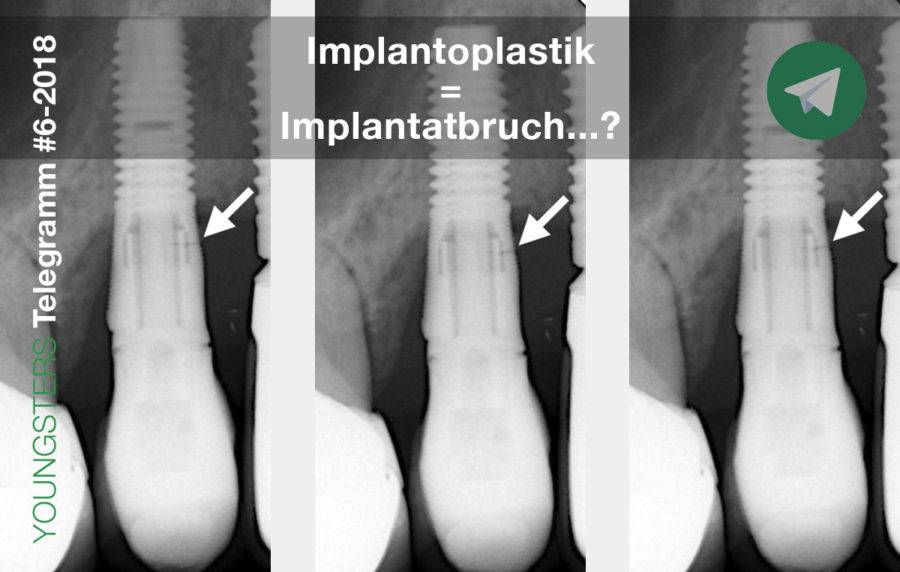 Implantoplastik = Implantatbruch…?